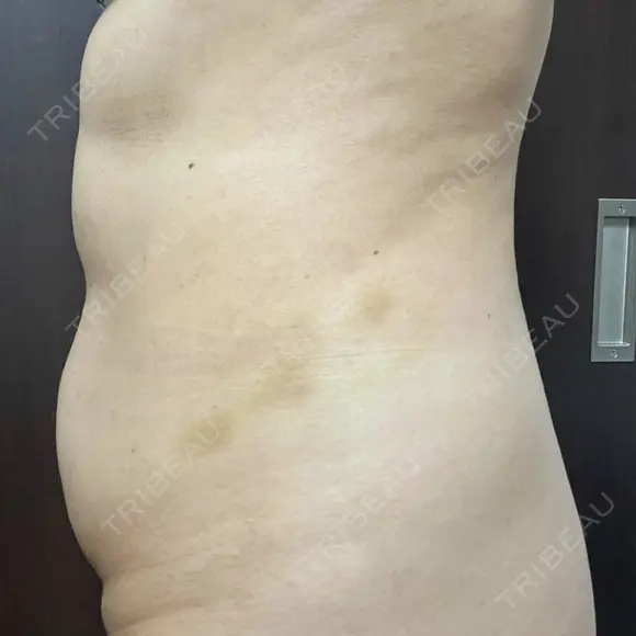 脂肪溶解注射（お腹） 渋谷美容外科クリニック 新宿院 DAY 5 メイン用