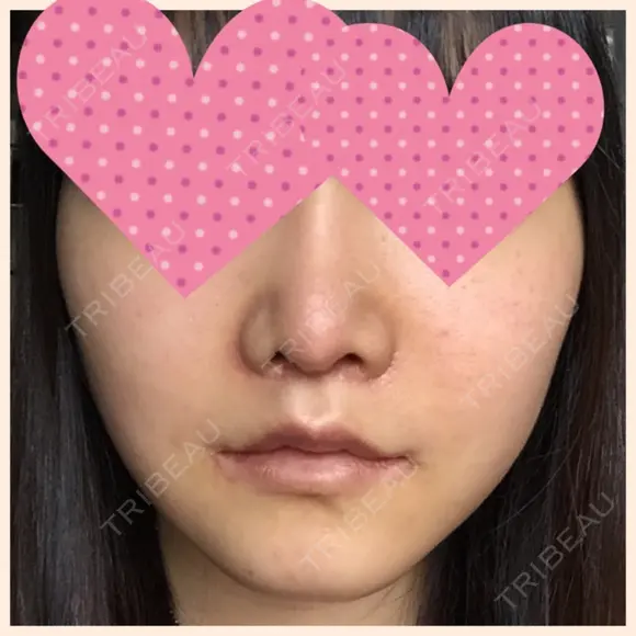 セットバック 大塚美容形成外科・歯科 大塚本院 DAY 35 メイン用