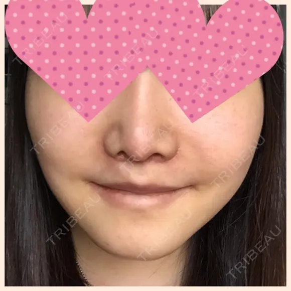 セットバック 大塚美容形成外科・歯科 大塚本院 DAY 35 メイン用