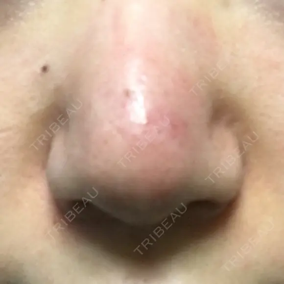 鼻尖形成（切開） / 小鼻縮小（切開） / 軟骨移植 牧野皮膚科医院 AFTER メイン用
