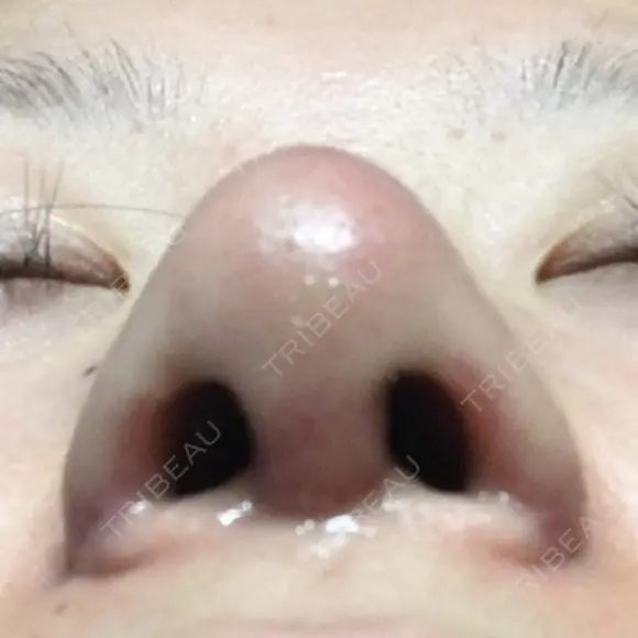 鼻尖形成（切開） / 小鼻縮小（切開） / 軟骨移植 牧野皮膚科医院 DAY 9 メイン用