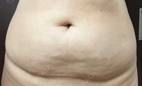 脂肪溶解注射（お腹） 渋谷美容外科クリニック 新宿院 DAY 7 メイン用