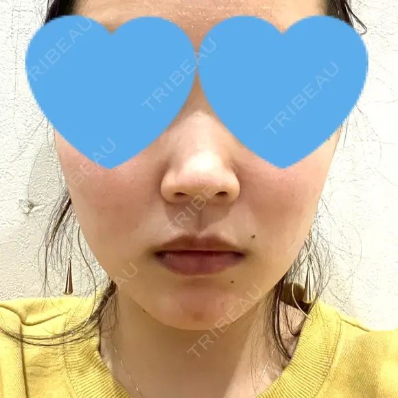 糸リフト / ボトックス（エラ・小顔） アリエル美容クリニック 大宮院 DAY 1 メイン用