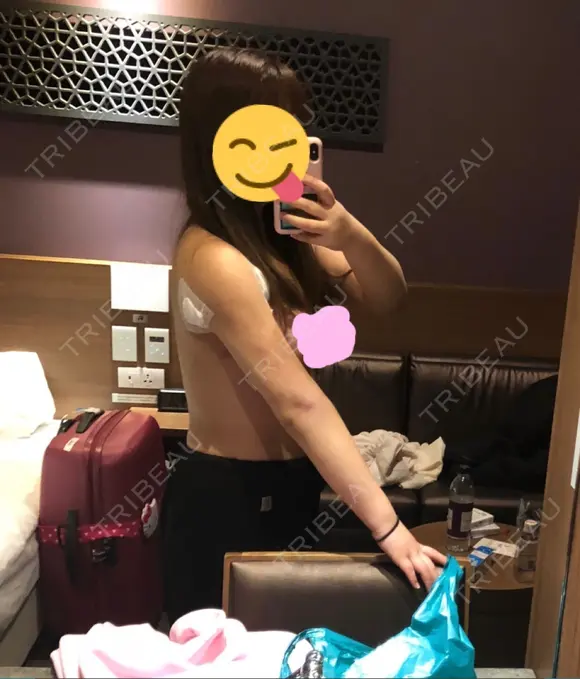 脂肪吸引（二の腕） ドクターフィット（Dr.fit）クリニック DAY 1 メイン用