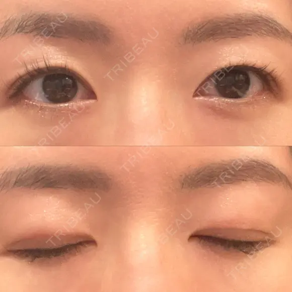 二重切開 城本クリニック 長崎院 DAY 100 メイン用