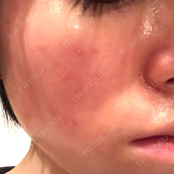 ピーリング（ニキビ・毛穴） / イオン導入 / ピーリング（ハリ・ツヤ） 渋谷美容外科クリニック 新橋院 DAY 3 メイン用