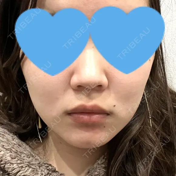 糸リフト / ボトックス（エラ・小顔） アリエル美容クリニック 大宮院 DAY 4 メイン用