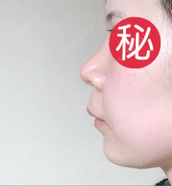 隆鼻術 / 鼻尖形成（切開） / 小鼻縮小（切開） / 軟骨移植 あいちビューティークリニック栄本院 DAY 31 メイン用