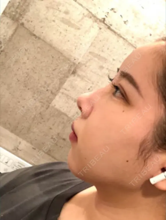 糸リフト / 脂肪吸引（顔） / ジョールファット除去 アリエル美容クリニック 大宮院 DAY 10 メイン用