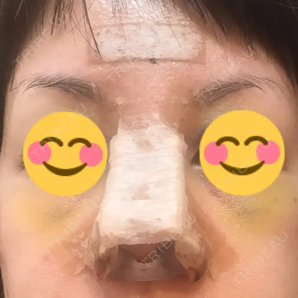 鼻尖形成（切開） / 鼻中隔延長（切開） / 軟骨移植 / 鼻尖縮小 / その他（鼻） ジョウクリニック 那覇院 DAY 4 メイン用