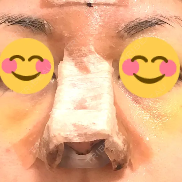 鼻尖形成（切開） / 鼻中隔延長（切開） / 軟骨移植 / 鼻尖縮小 / その他（鼻） ジョウクリニック 那覇院 DAY 5 メイン用