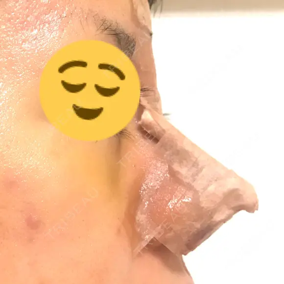 鼻尖形成（切開） / 鼻中隔延長（切開） / 軟骨移植 / 鼻尖縮小 / その他（鼻） ジョウクリニック 那覇院 DAY 5 メイン用