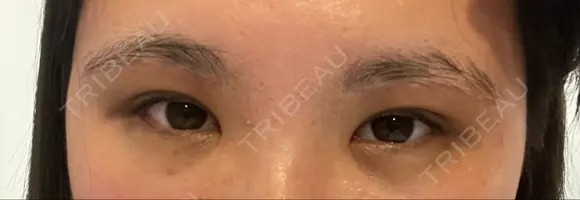 脂肪吸引（顔） / 上まぶたの脂肪取り / 下まぶたの脂肪取り / 眉下切開 LIKI CLINIC KOBE DAY 11 メイン用