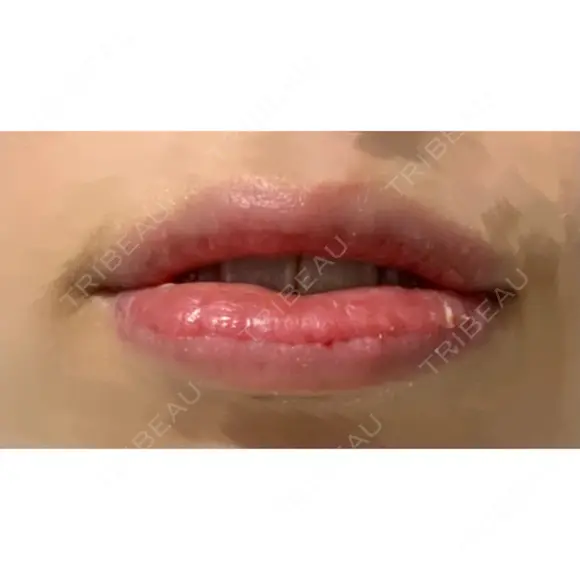 口唇縮小術 / ヒアルロン酸注入（頬） B-LINE CLINIC 池袋院 DAY 6 メイン用