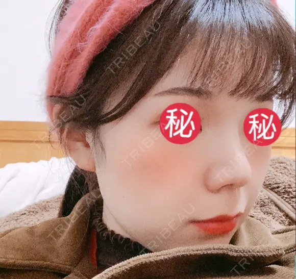 隆鼻術 / 鼻尖形成（切開） / 小鼻縮小（切開） / 軟骨移植 あいちビューティークリニック栄本院 DAY 34 メイン用