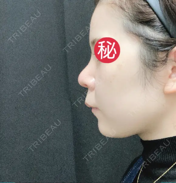 隆鼻術 / 鼻尖形成（切開） / 小鼻縮小（切開） / 軟骨移植 あいちビューティークリニック栄本院 DAY 34 メイン用