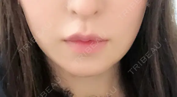 骨切り（あご） / 輪郭修正 / ボトックス（エラ・小顔） 心斎橋コムロ美容外科クリニック DAY 95 メイン用