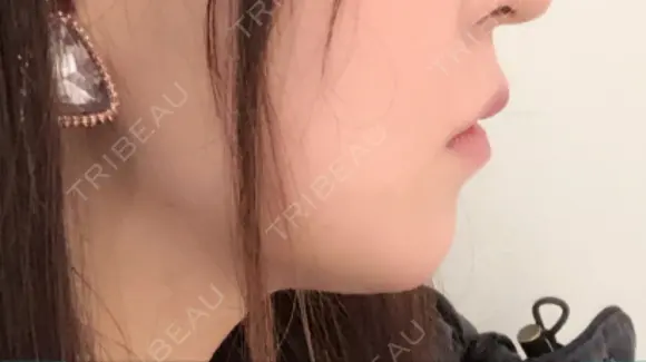 骨切り（あご） / 輪郭修正 / ボトックス（エラ・小顔） 心斎橋コムロ美容外科クリニック DAY 95 メイン用