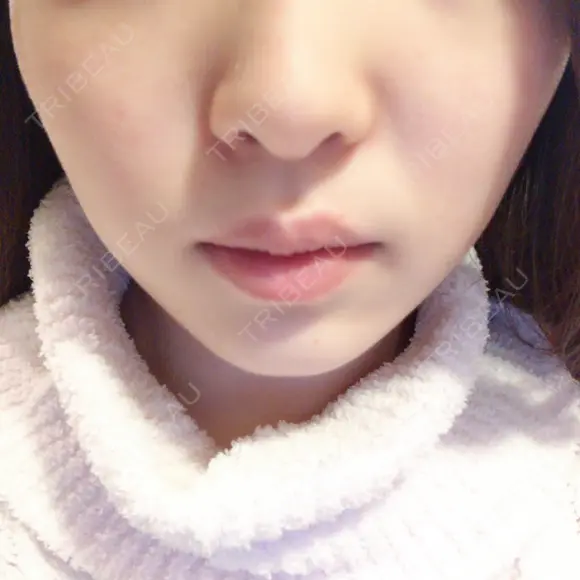 脂肪溶解注射（顔） S Beauty Clinic DAY 26 メイン用