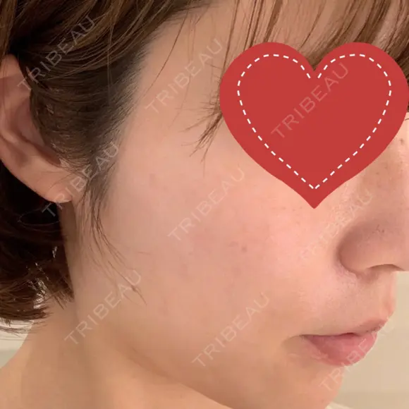 シミ取りレーザー 渋谷美容外科クリニック 新橋院 AFTER メイン用