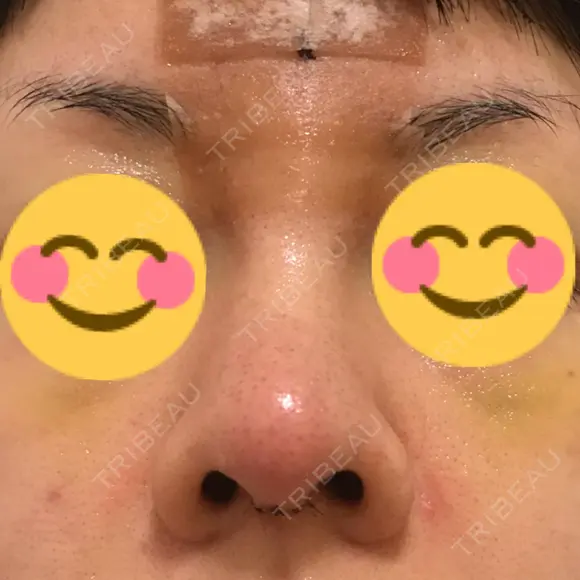 鼻尖形成（切開） / 鼻中隔延長（切開） / 軟骨移植 / 鼻尖縮小 / その他（鼻） ジョウクリニック 那覇院 DAY 7 メイン用