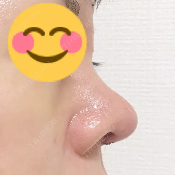 鼻尖形成（切開） / 鼻中隔延長（切開） / 軟骨移植 / 鼻尖縮小 / その他（鼻） ジョウクリニック 那覇院 DAY 7 メイン用