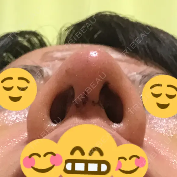 鼻尖形成（切開） / 鼻中隔延長（切開） / 軟骨移植 / 鼻尖縮小 / その他（鼻） ジョウクリニック 那覇院 DAY 7 メイン用