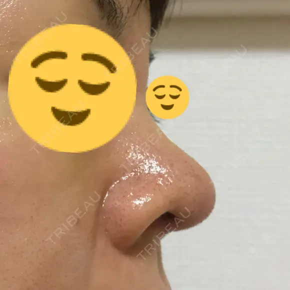 鼻尖形成（切開） / 鼻中隔延長（切開） / 軟骨移植 / 鼻尖縮小 / その他（鼻） ジョウクリニック 那覇院 DAY 9 メイン用