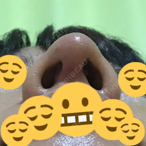 鼻尖形成（切開） / 鼻中隔延長（切開） / 軟骨移植 / 鼻尖縮小 / その他（鼻） ジョウクリニック 那覇院 DAY 9 メイン用