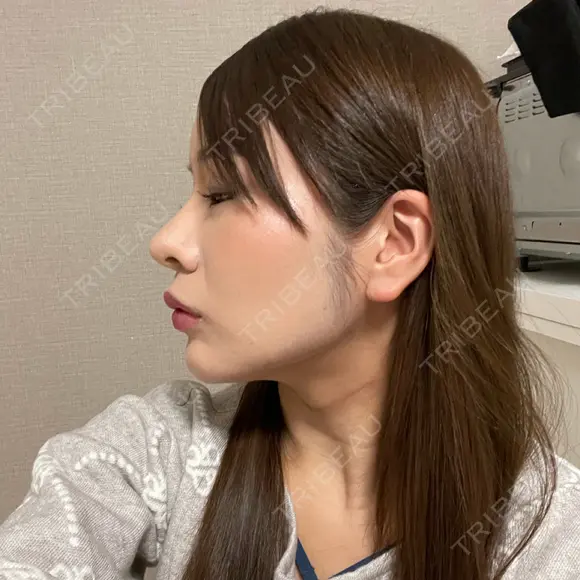 鼻尖形成（切開） / 鼻中隔延長（切開） / 小鼻縮小（切開） / 骨切幅寄せ / ワシ鼻修正・ハンプ切除 / 脂肪注入（額） Zetith Beauty Clinic 銀座院 DAY 100 メイン用