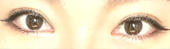 二重切開 / 目頭切開 / 上まぶたの脂肪取り 樹のひかり 形成外科・皮ふ科 AFTER メイン用