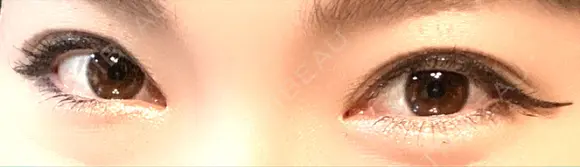 二重切開 / 目頭切開 / 上まぶたの脂肪取り 樹のひかり 形成外科・皮ふ科 DAY 328 メイン用