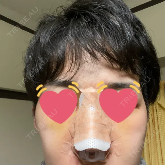 隆鼻術 / 軟骨移植 銀座S美容・形成外科クリニック DAY 4 メイン用