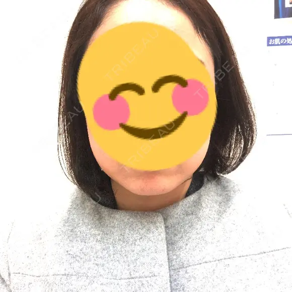 脂肪溶解注射（顔） 聖心美容クリニック 福岡院 DAY 4 メイン用