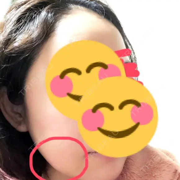 脂肪溶解注射（顔） 聖心美容クリニック 福岡院 DAY 5 メイン用