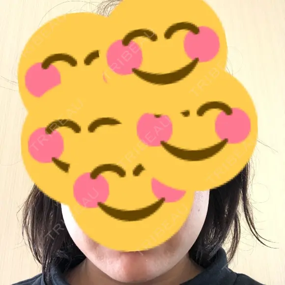 脂肪溶解注射（顔） 聖心美容クリニック 福岡院 DAY 14 メイン用