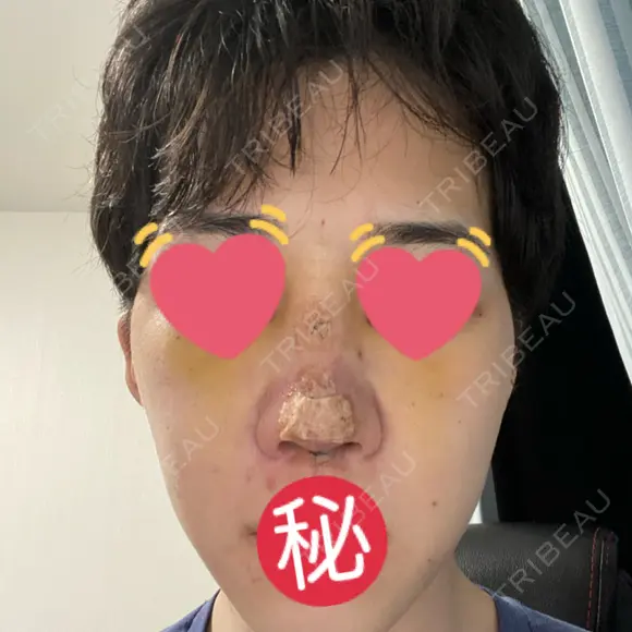 隆鼻術 / 軟骨移植 銀座S美容・形成外科クリニック DAY 5 メイン用