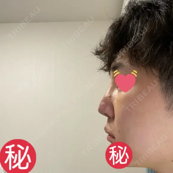 隆鼻術 / 軟骨移植 銀座S美容・形成外科クリニック DAY 6 メイン用