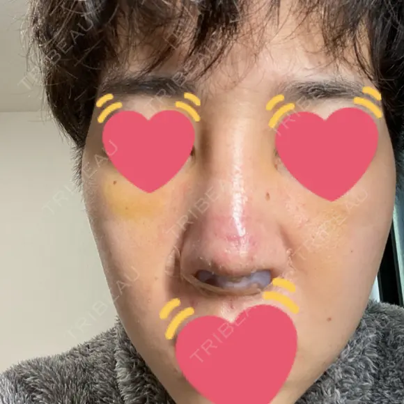 隆鼻術 / 軟骨移植 銀座S美容・形成外科クリニック DAY 7 メイン用