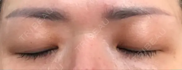 眉下切開 湘南美容クリニック 大阪京橋院 DAY 274 メイン用
