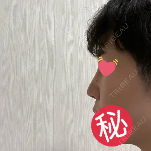 隆鼻術 / 軟骨移植 銀座S美容・形成外科クリニック DAY 8 メイン用