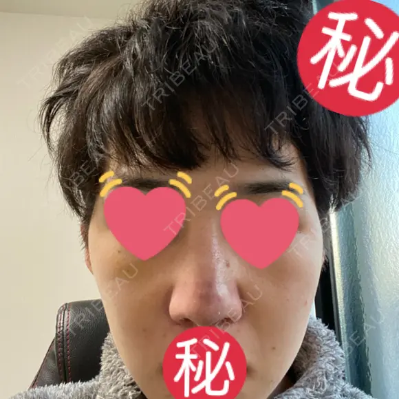 隆鼻術 / 軟骨移植 銀座S美容・形成外科クリニック DAY 9 メイン用