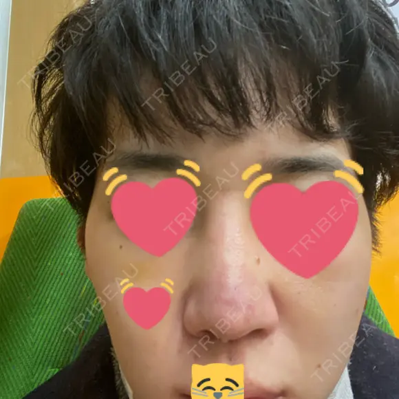 隆鼻術 / 軟骨移植 銀座S美容・形成外科クリニック DAY 9 メイン用