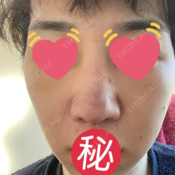 隆鼻術 / 軟骨移植 銀座S美容・形成外科クリニック AFTER メイン用