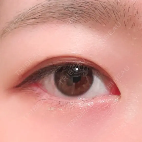 二重埋没 湘南美容クリニック 上野院 AFTER メイン用