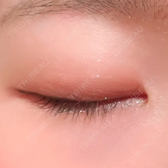 二重埋没 湘南美容クリニック 上野院 DAY 35 メイン用