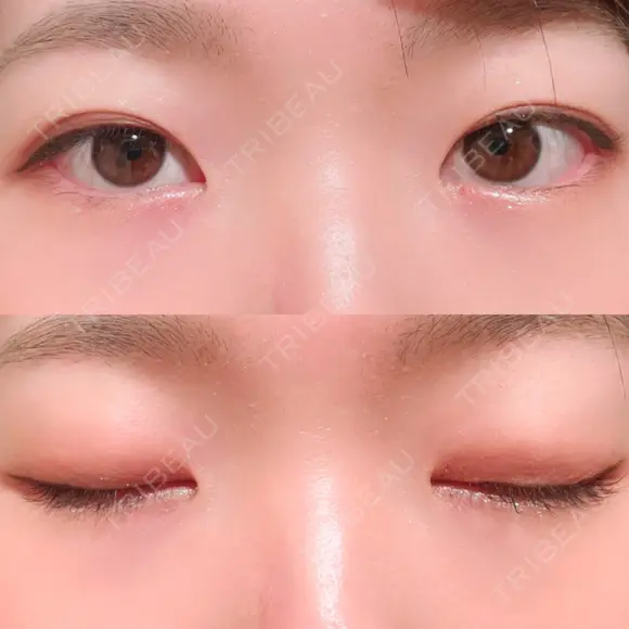 二重埋没 湘南美容クリニック 上野院 DAY 35 メイン用