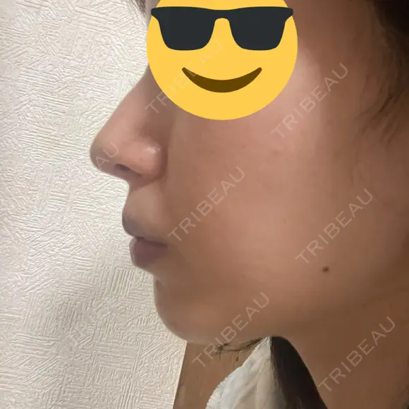 鼻尖形成（切開） / 軟骨移植 フェアクリニック川口 AFTER メイン用