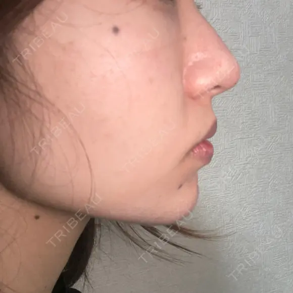 鼻尖形成（切開） / 軟骨移植 フェアクリニック川口 DAY 23 メイン用