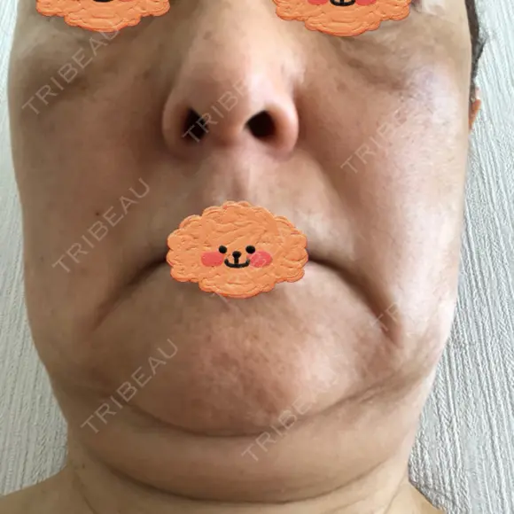脂肪吸引（顔） / 脂肪注入（額） / 切開リフト 札幌ル・トロワ ビューティクリニックVogue DAY 70 メイン用